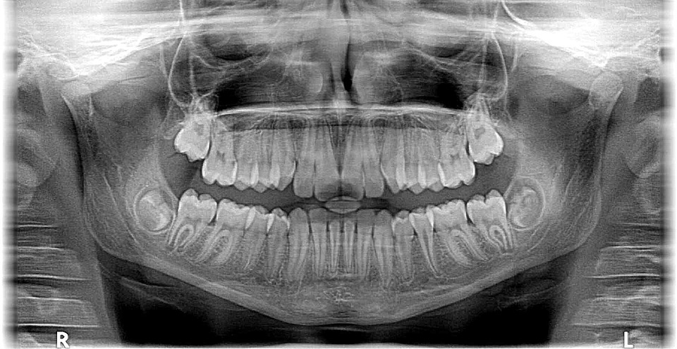 Le radiografie odontoiatriche